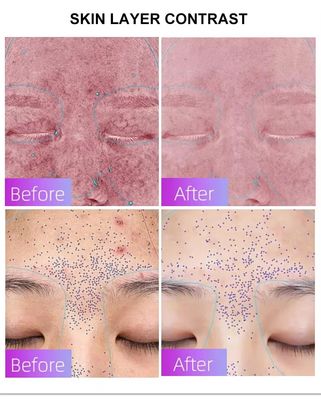 주문 Blue Light Acne Treatment Mask with Intelligent Timer – Manufacturer Direct Supply, Appearance Patent Included 온라인 제품